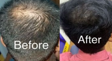Hair Transplant – 6 Months Later