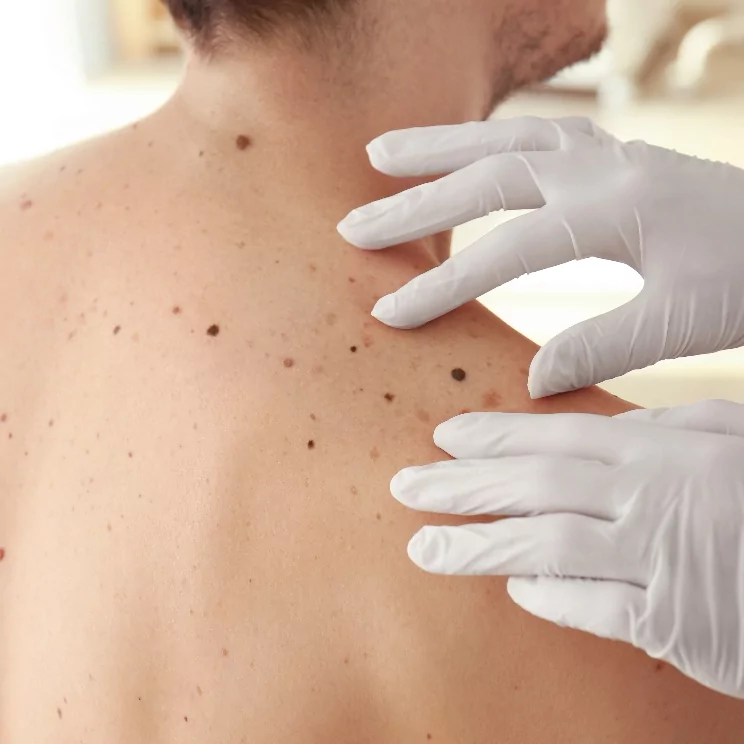 Skin Treatment